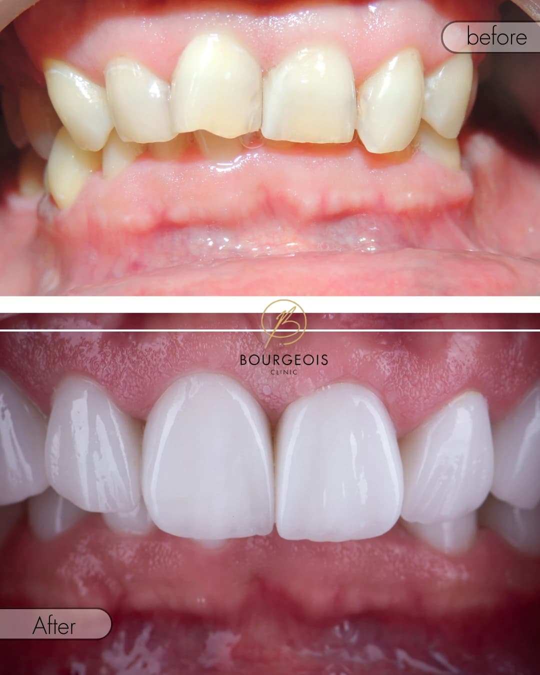 Dental Veneers in Dubai - Case 1 | Bourgeois Dental Clinic