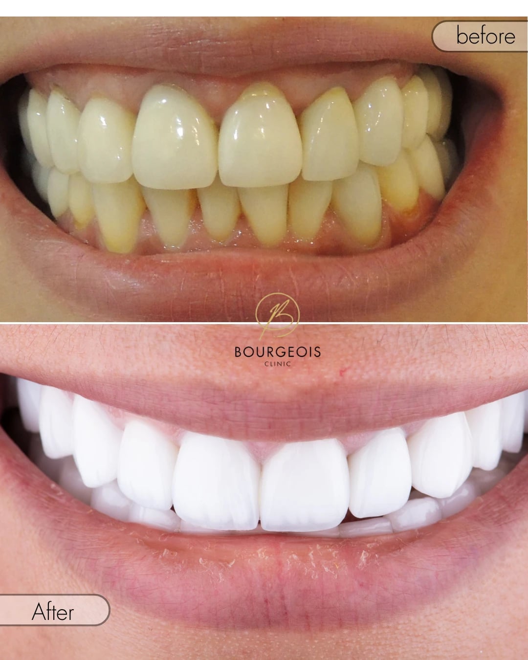 Hollywood Smile | Bourgeois Dental Clinic Dubai