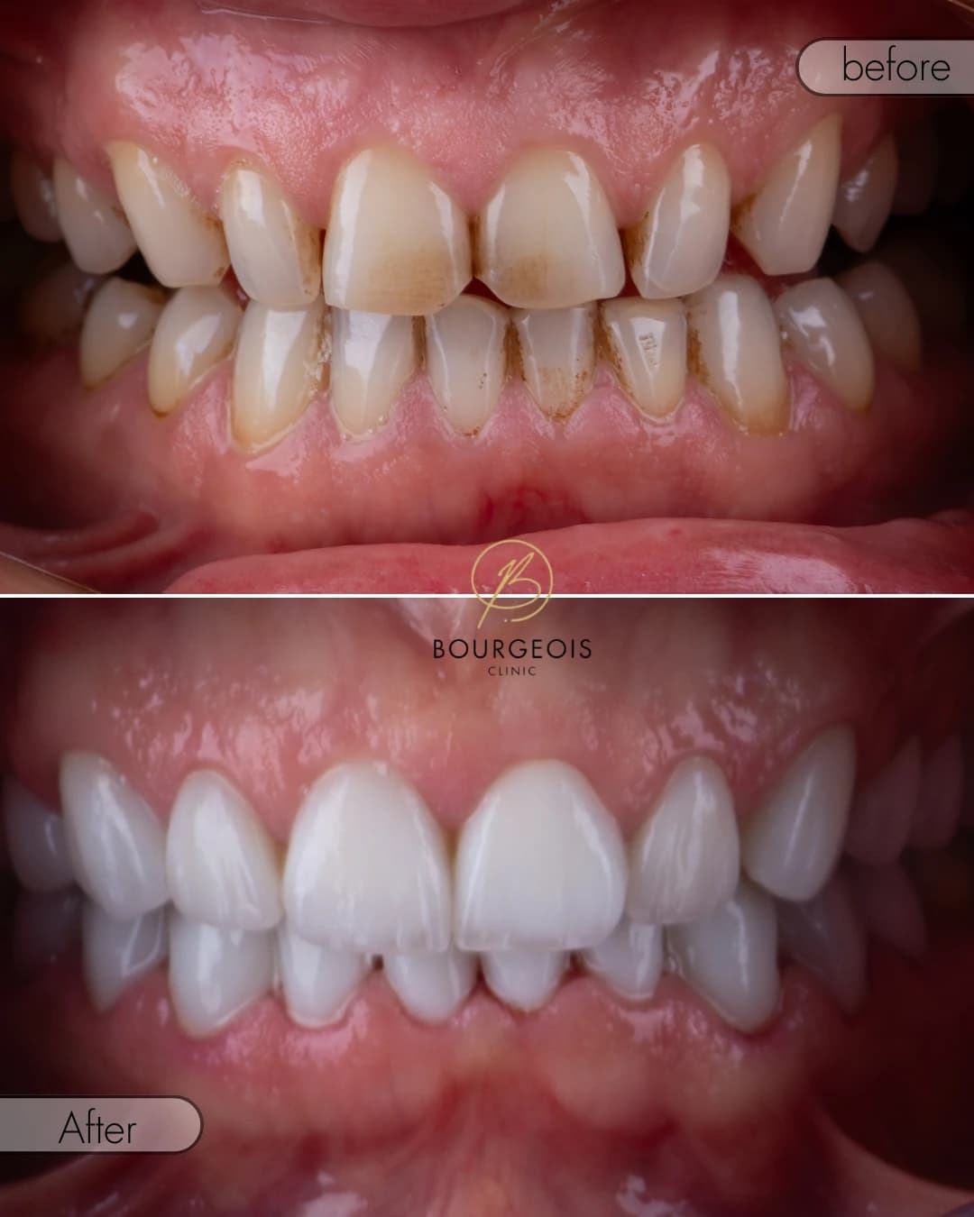 Dental Veneers in Dubai - Case 2 | Bourgeois Dental Clinic