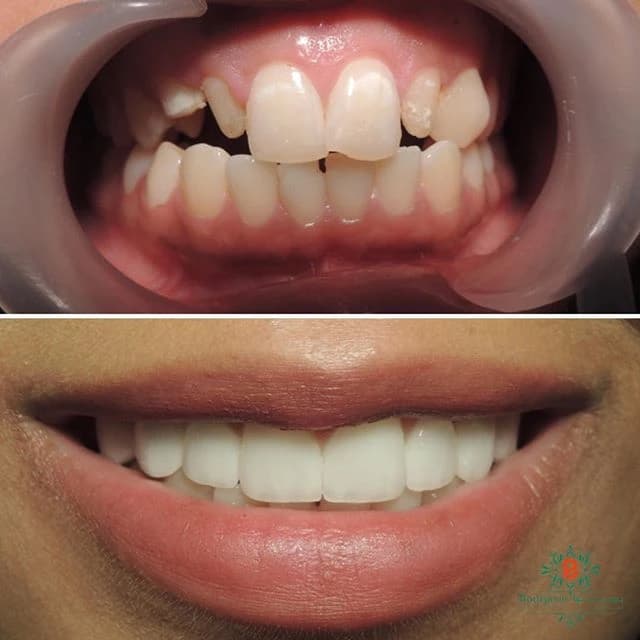 عيادة بورجوا لطب الأسنان - حالة 6 | عيادة بورجوا لطب الأسنان