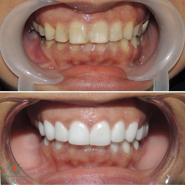 Bourgeois Dental Clinic - Case 7 | Bourgeois Dental Clinic