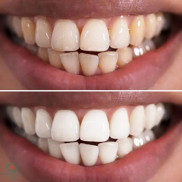 Bourgeois Dental Clinic - Case 8 | Bourgeois Dental Clinic