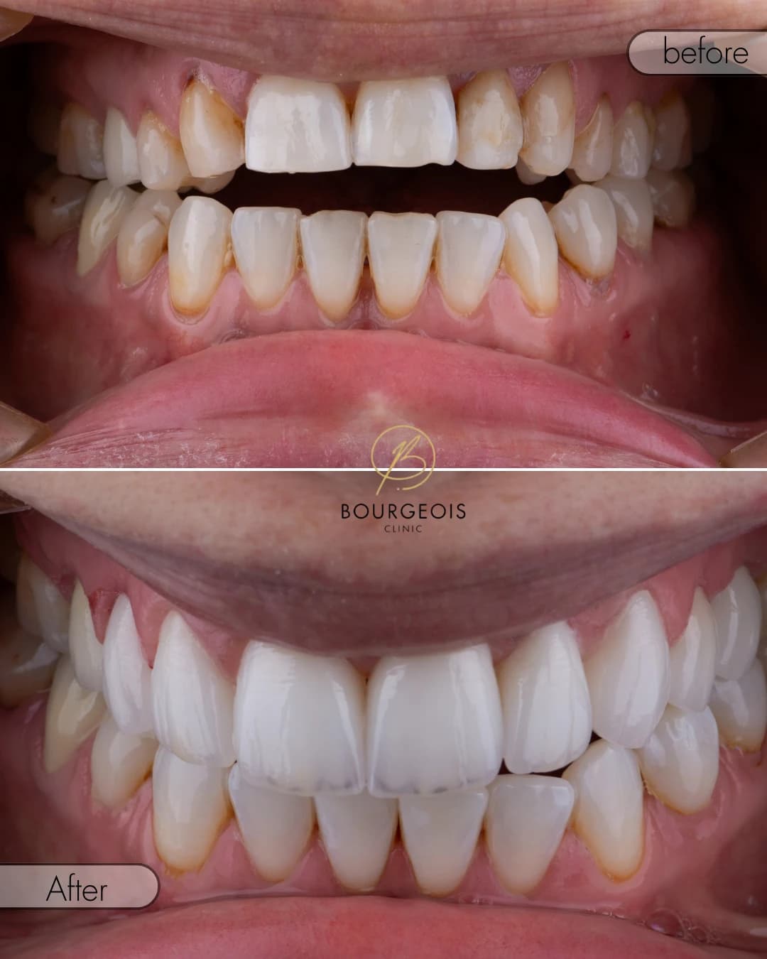 Dental Veneers in Dubai