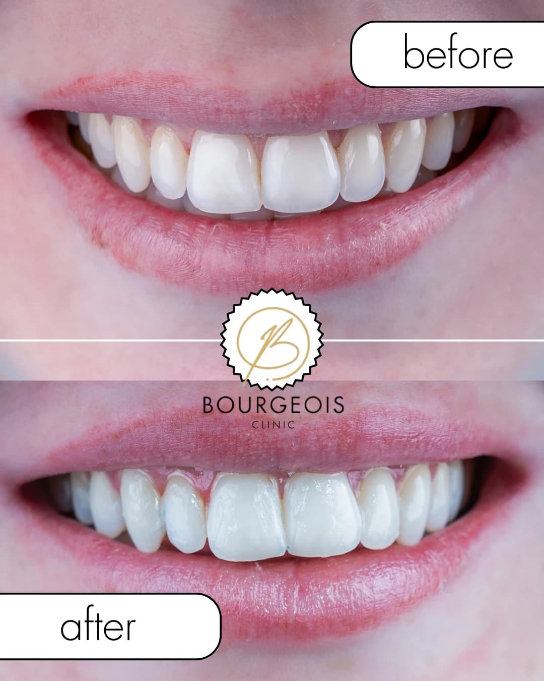 Bourgeois Dental Clinic - Case 2 | Bourgeois Dental Clinic