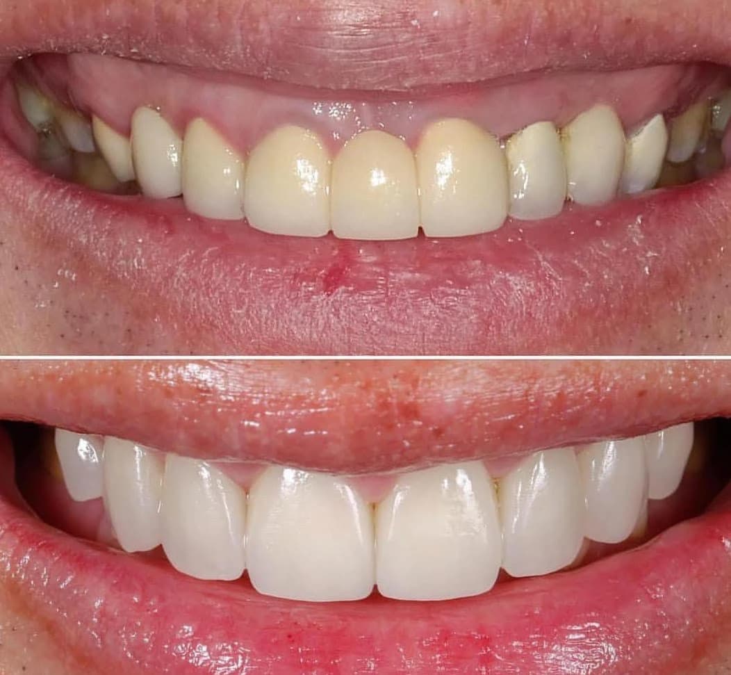 عيادة بورجوا لطب الأسنان - حالة 4 | عيادة بورجوا لطب الأسنان