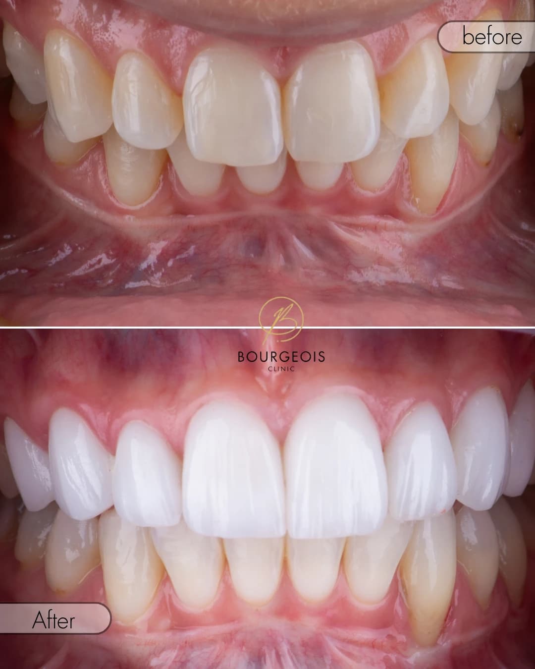 Bourgeois Dental Clinic - Case 8 | Bourgeois Dental Clinic