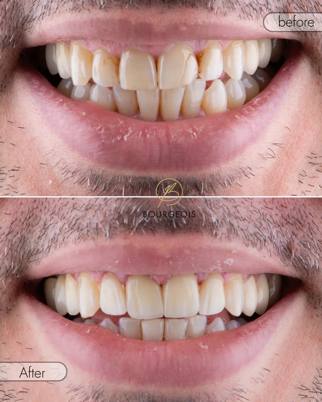 Bourgeois Dental Clinic - Case 4 | Bourgeois Dental Clinic