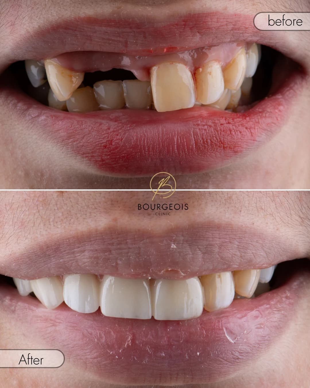Bourgeois Dental Clinic - Case 1 | Bourgeois Dental Clinic