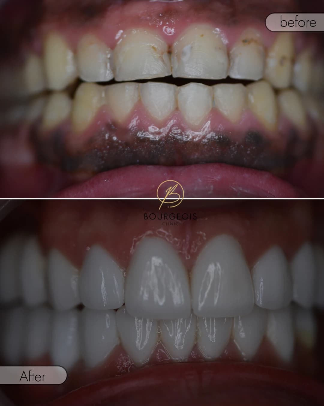 Dental Veneers in Dubai - Case 5 | Bourgeois Dental Clinic