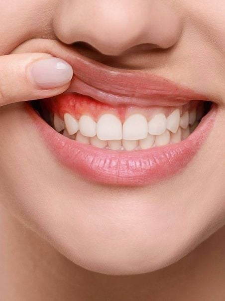 استشارة وفحص اللثة | عيادة بورجوا لطب الأسنان دبي