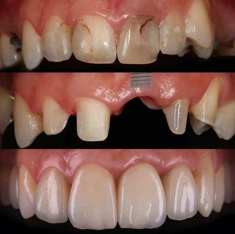 عيادة بورجوا لطب الأسنان - حالة 3 | عيادة بورجوا لطب الأسنان