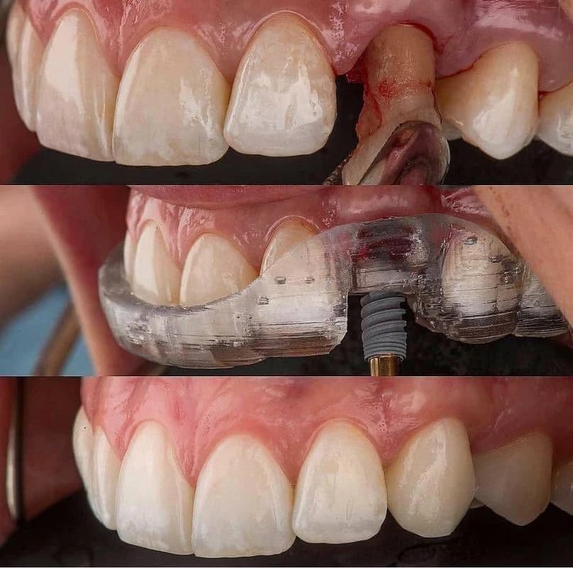 عيادة بورجوا لطب الأسنان - حالة 4 | عيادة بورجوا لطب الأسنان