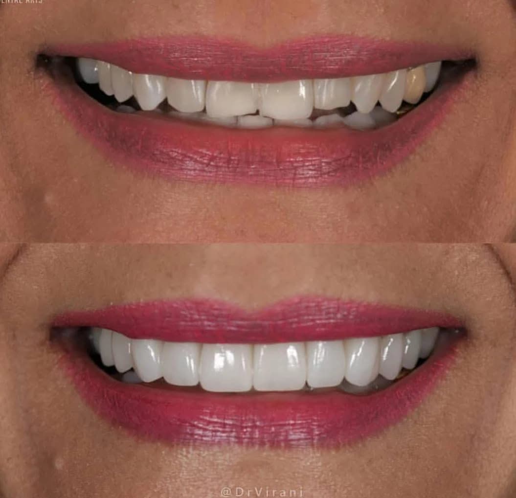 عيادة بورجوا لطب الأسنان - حالة 3 | عيادة بورجوا لطب الأسنان